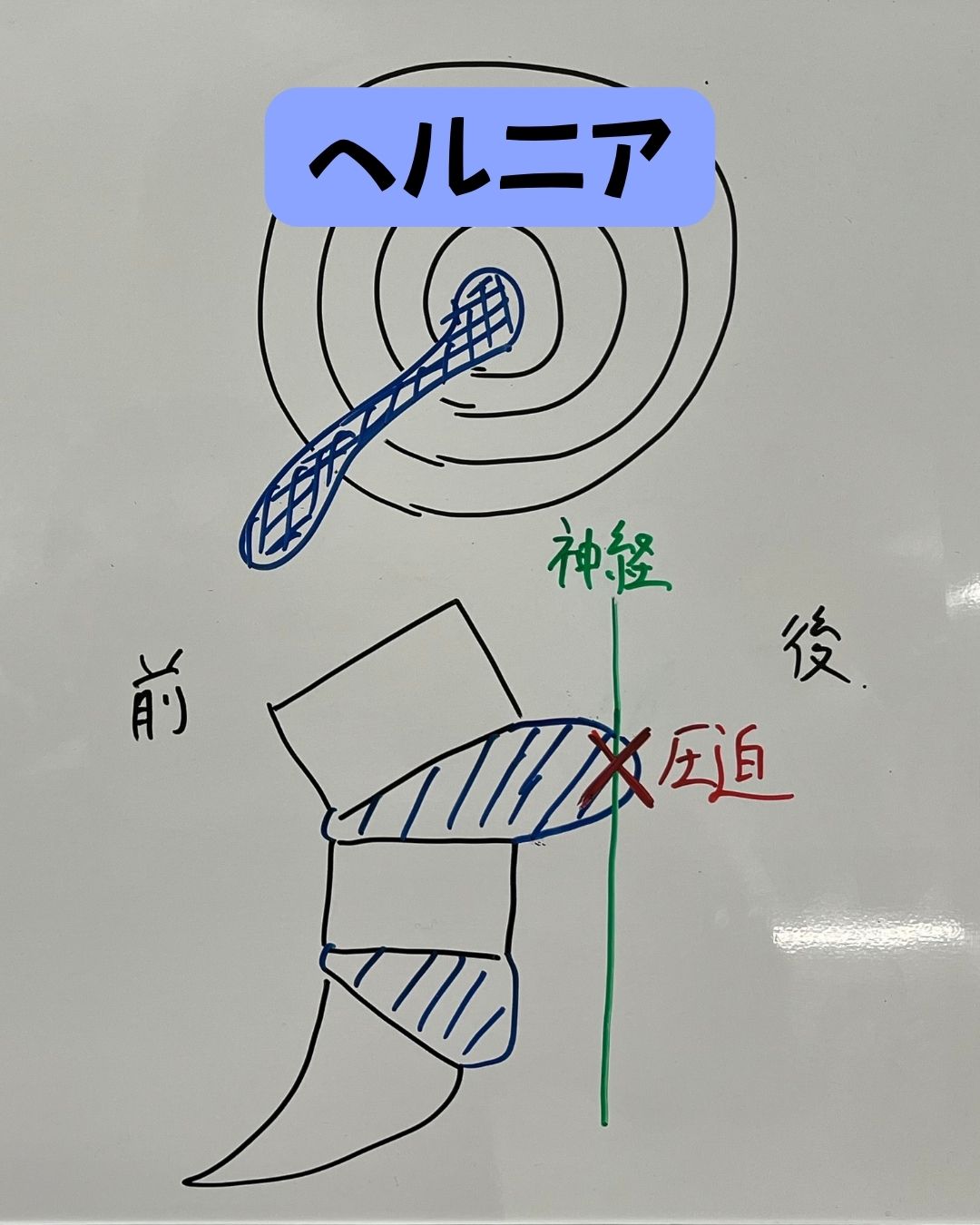 椎間板ヘルニア　ヘルニア