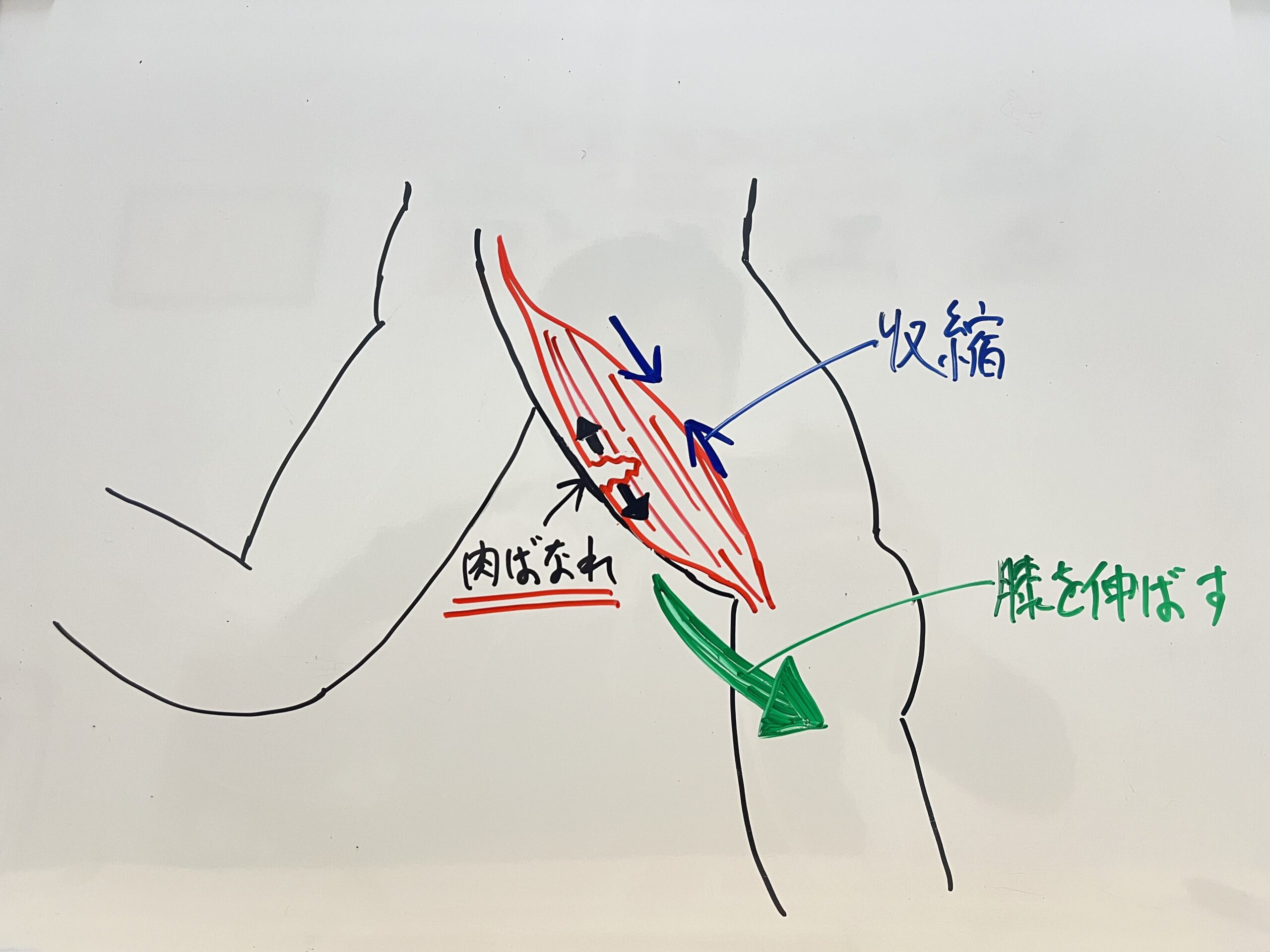 肉離れ