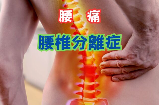 腰椎分離症