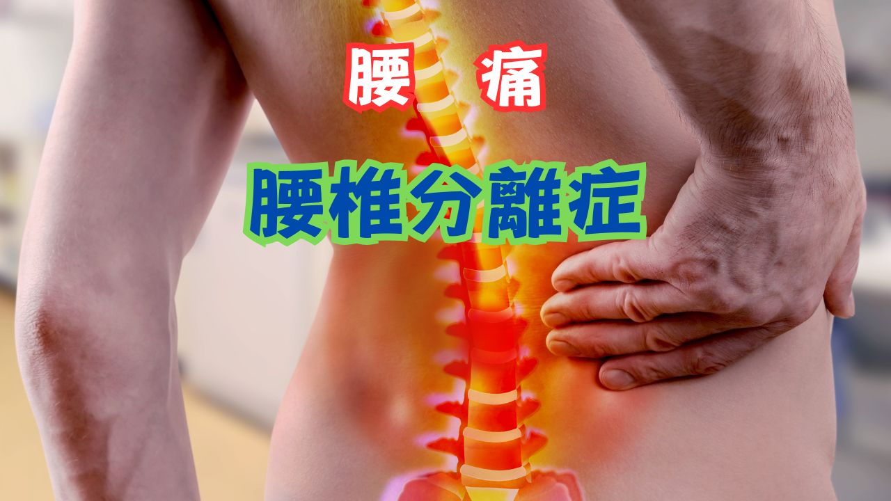 腰椎分離症